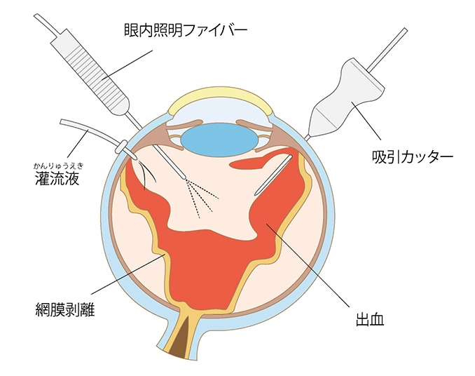 末期の治療　硝子体手術