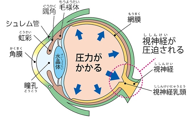 緑内障の原因