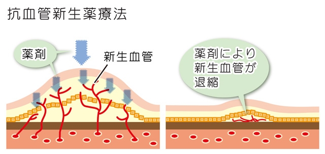 抗VEGF療法（抗血管新生薬療法）