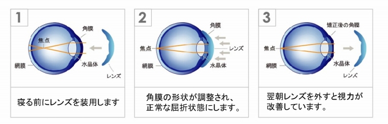 世界中で注目される近視矯正術